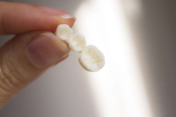 Bridges vs. Dental Implants: Which Is Better from Hermann Park Smiles in Houston, TX
