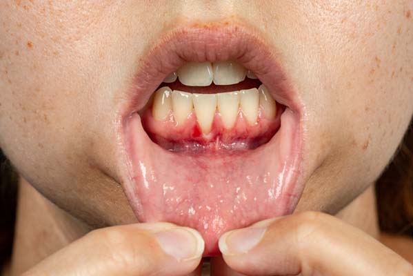A Dentist Explains The Dangers Of Gum Disease